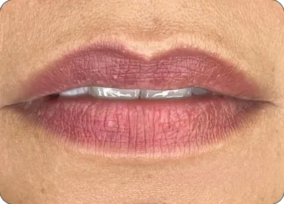 Resultado de micropigmentação labial pálido e sem vivacidade após cicatrização
