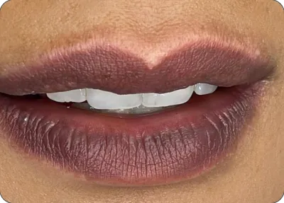 Resultado labial escurecido e oxidado após cicatrização