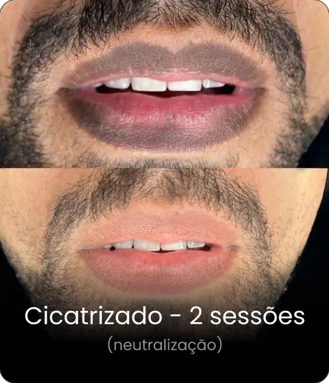 Resultado cicatrizado 1