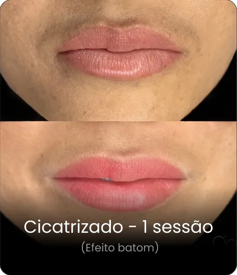 Resultado cicatrizado 3