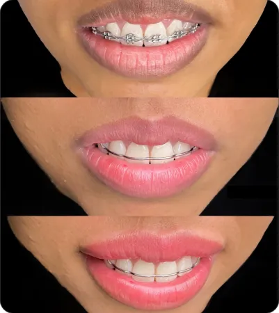 Evolução do retoque: sessão 1, retoque e resultado final